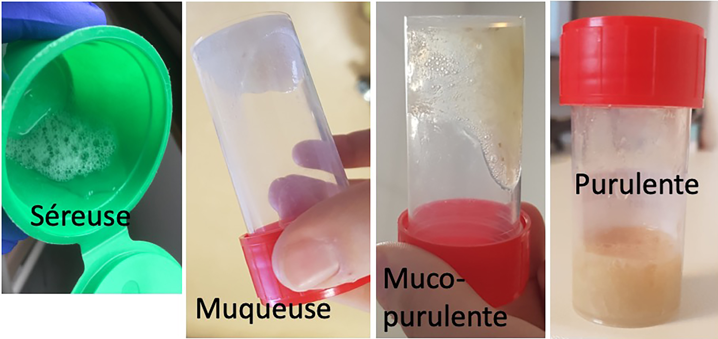 S miologie Pneumologique